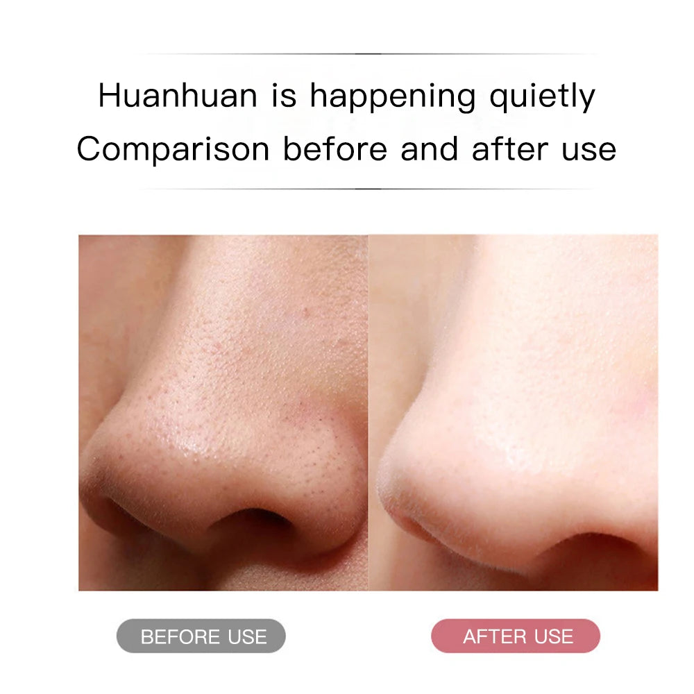 Limpiador Facial Ultrasónico